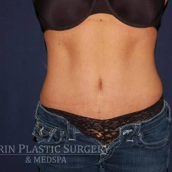 Abdominoplasty - With Liposuction of The Waist Before & After Patient #1330