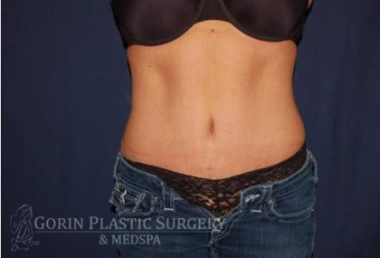 Abdominoplasty - With Liposuction of The Waist Before & After Patient #1330