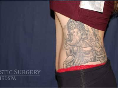Abdominoplasty - With Liposuction of The Waist Before & After Patient #1335