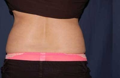 Abdominoplasty - With Liposuction of The Waist Before & After Patient #1339