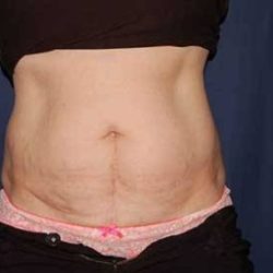 Abdominoplasty - With Liposuction of The Waist Before & After Patient #1339