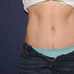 Abdominoplasty - With Liposuction of The Waist Before & After Patient #1339