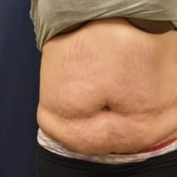 Abdominoplasty - With Liposuction of The Waist Before & After Patient #1344