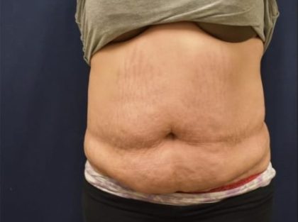 Abdominoplasty - With Liposuction of The Waist Before & After Patient #1344