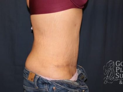 Abdominoplasty - With Liposuction of The Waist Before & After Patient #1344