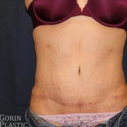 Abdominoplasty - With Liposuction of The Waist Before & After Patient #1344