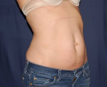 Abdominoplasty - With Liposuction of The Waist Before & After Patient #1348