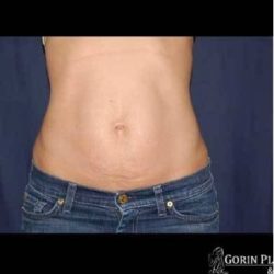 Abdominoplasty - With Liposuction of The Waist Before & After Patient #1348