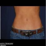Abdominoplasty - With Liposuction of The Waist Before & After Patient #1348