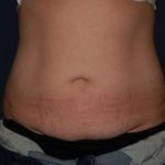 Abdominoplasty - With Liposuction of The Waist Before & After Patient #1353