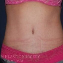 Abdominoplasty - With Liposuction of The Waist Before & After Patient #1353