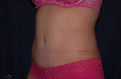 Abdominoplasty - With Liposuction of The Waist Before & After Patient #1353