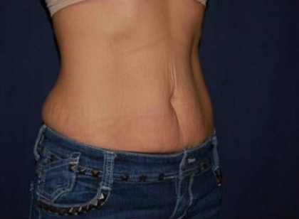 Abdominoplasty - With Liposuction of The Waist Before & After Patient #1357