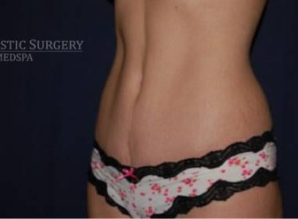Abdominoplasty - With Liposuction of The Waist Before & After Patient #1357