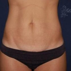 Abdominoplasty - With Liposuction of The Waist Before & After Patient #1357