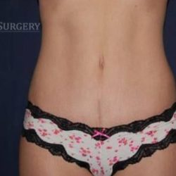 Abdominoplasty - With Liposuction of The Waist Before & After Patient #1357