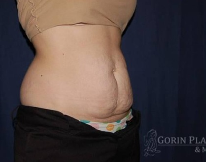 Abdominoplasty - With Liposuction of The Waist Before & After Patient #1361