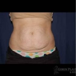 Abdominoplasty - With Liposuction of The Waist Before & After Patient #1361