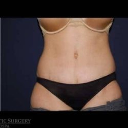 Abdominoplasty - With Liposuction of The Waist Before & After Patient #1361