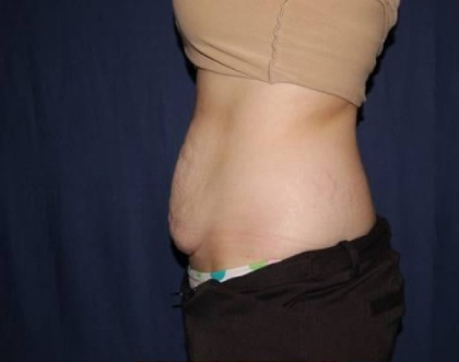 Abdominoplasty - With Liposuction of The Waist Before & After Patient #1361