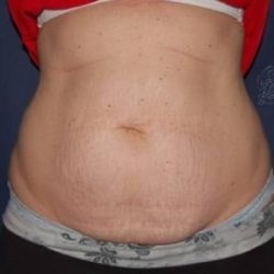 Abdominoplasty - With Liposuction of The Waist Before & After Patient #1366