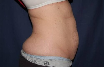 Abdominoplasty - With Liposuction of The Waist Before & After Patient #1366
