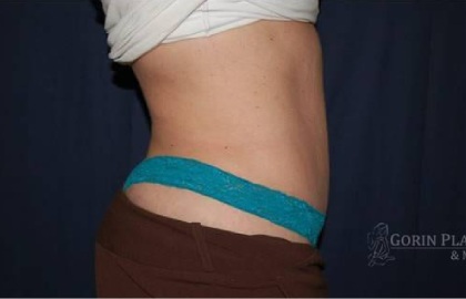 Abdominoplasty - With Liposuction of The Waist Before & After Patient #1366