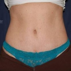 Abdominoplasty - With Liposuction of The Waist Before & After Patient #1366
