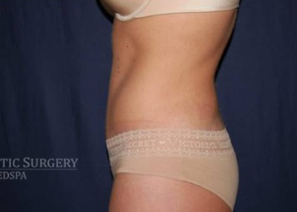 Abdominoplasty - With Liposuction of The Waist Before & After Patient #1370