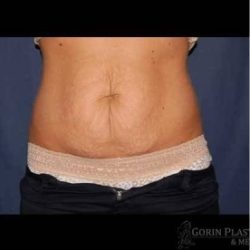 Abdominoplasty - With Liposuction of The Waist Before & After Patient #1370