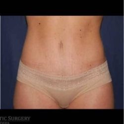 Abdominoplasty - With Liposuction of The Waist Before & After Patient #1370