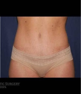 Abdominoplasty - With Liposuction of The Waist Before & After Patient #1370