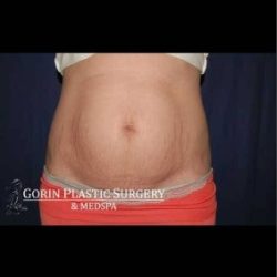 Abdominoplasty - With Liposuction of The Waist Before & After Patient #1374