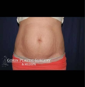 Abdominoplasty - With Liposuction of The Waist Before & After Patient #1374