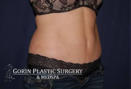 Abdominoplasty - With Liposuction of The Waist Before & After Patient #1374