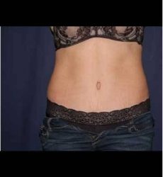 Abdominoplasty - With Liposuction of The Waist Before & After Patient #1374