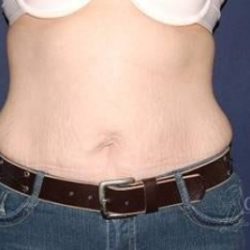 Abdominoplasty - With Liposuction of The Waist Before & After Patient #1379