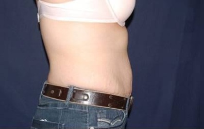 Abdominoplasty - With Liposuction of The Waist Before & After Patient #1379