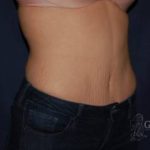 Abdominoplasty - With Liposuction of The Waist Before & After Patient #1379