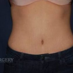 Abdominoplasty - With Liposuction of The Waist Before & After Patient #1379