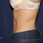 Abdominoplasty - With Liposuction of The Waist Before & After Patient #1384