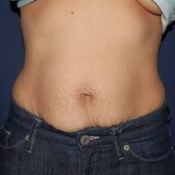 Abdominoplasty - With Liposuction of The Waist Before & After Patient #1384
