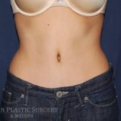 Abdominoplasty - With Liposuction of The Waist Before & After Patient #1384