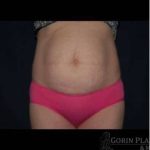 Abdominoplasty - With Liposuction of The Waist Before & After Patient #1389
