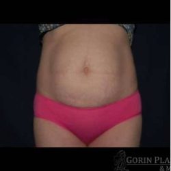 Abdominoplasty - With Liposuction of The Waist Before & After Patient #1389