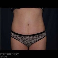 Abdominoplasty - With Liposuction of The Waist Before & After Patient #1389