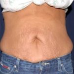 Abdominoplasty - With Liposuction of The Waist Before & After Patient #1394