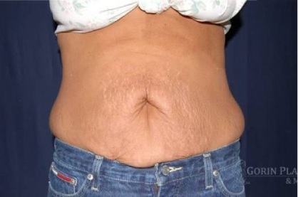 Abdominoplasty - With Liposuction of The Waist Before & After Patient #1394