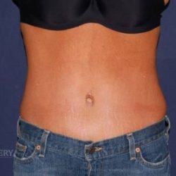 Abdominoplasty - With Liposuction of The Waist Before & After Patient #1394