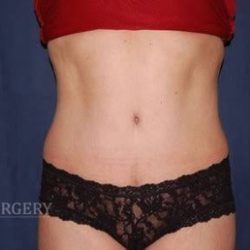 Abdominoplasty - With Liposuction of The Waist Before & After Patient #1398